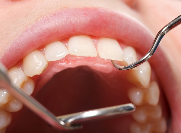 虫歯の再発を予防し、生涯を通じて健康な歯を維持しましょう