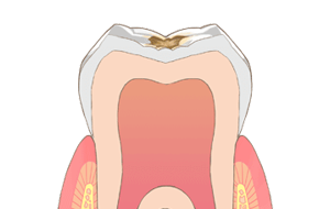 歯の表面（エナメル質）の虫歯