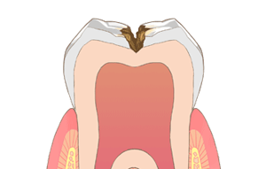 歯の中（象牙質）の虫歯